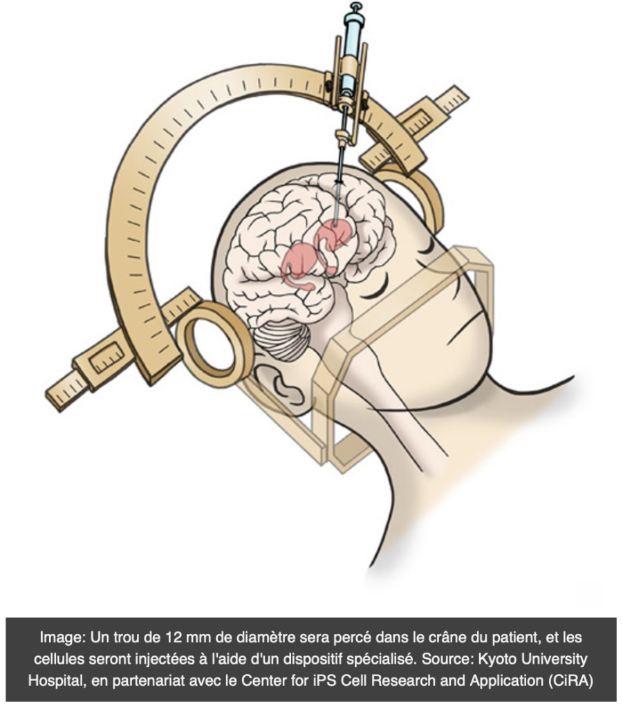 Screenshot 2025 01 31 at 8.40.23 PM - Parkinson: le secret des cellules souches dormantes!